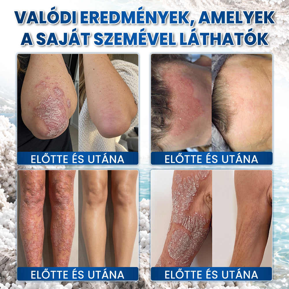 Medistart® PSZORIÁZIS SPECIÁLIS BŐRÁPOLÓ